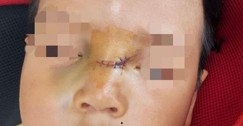 脸部缝针后吃矮瓜行吗